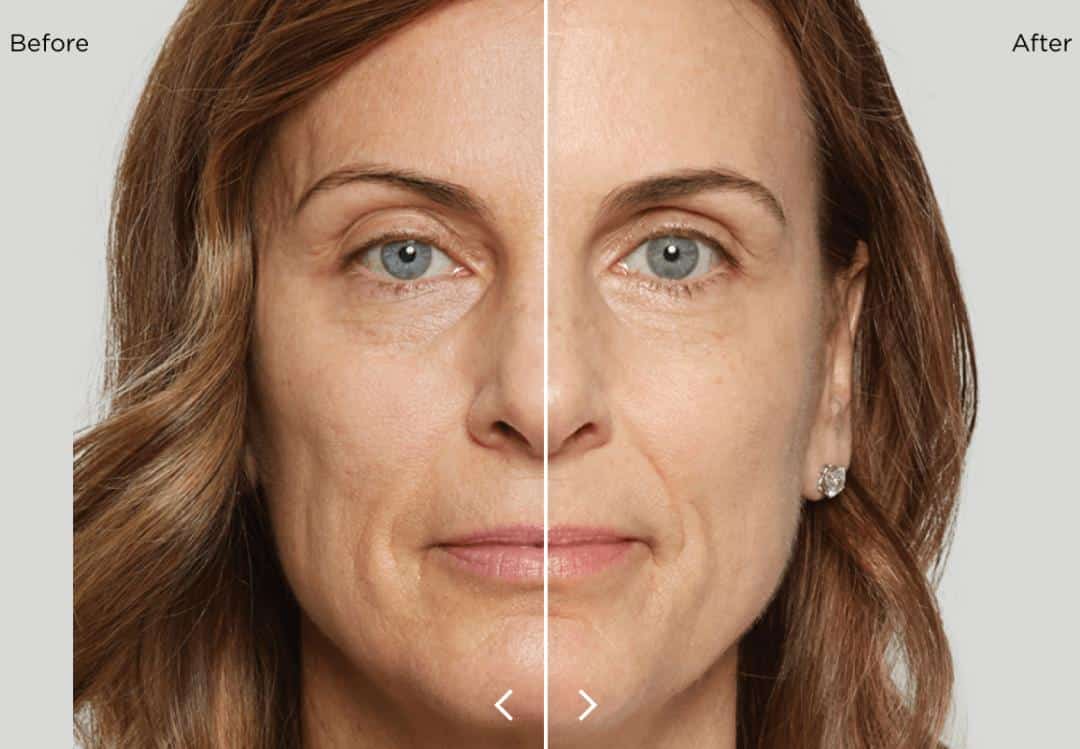 Before & After Collagen Stimulator College Station TX