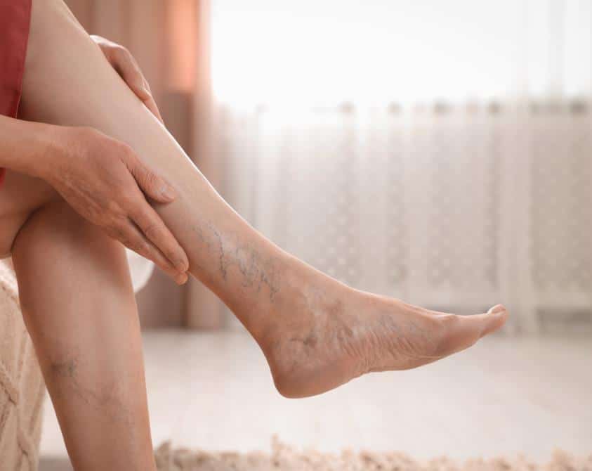Spider Vein Treatment College Station TX