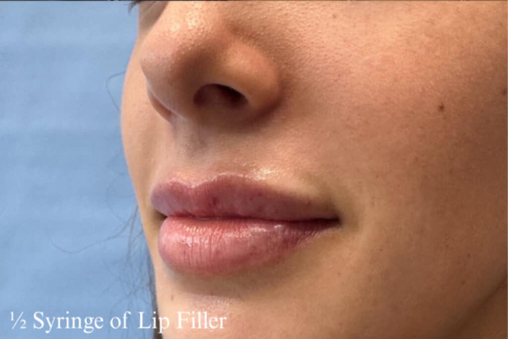 After Image: Lip Filler - left-front-oblique