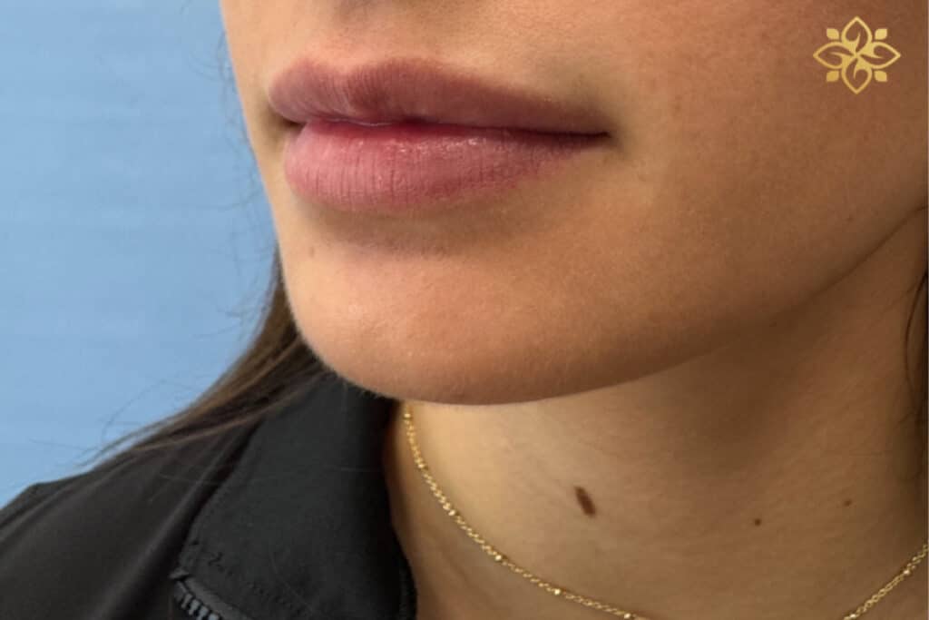 Before Image: Lip Filler - left-front-oblique