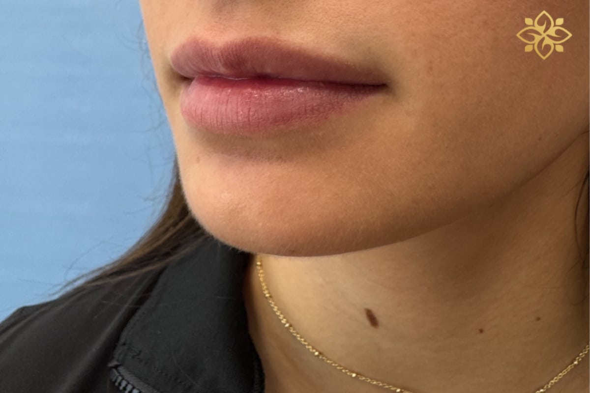 Before Image: Before & After - left-front-oblique