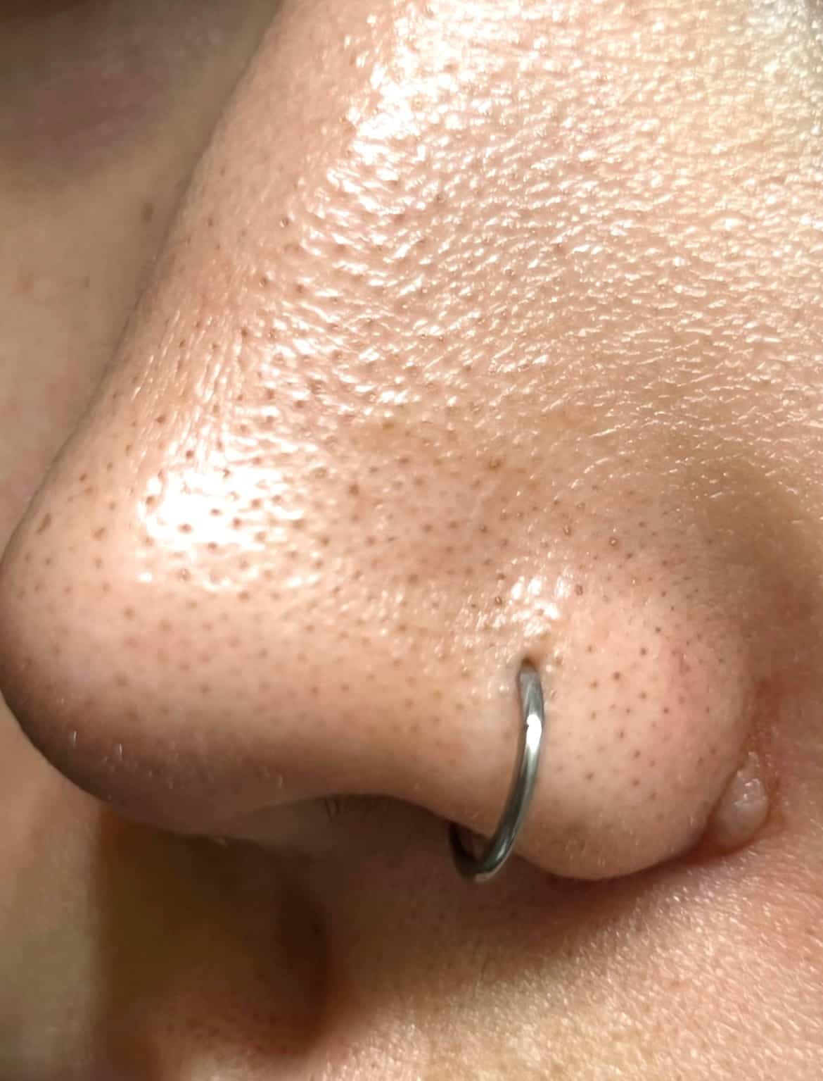 Before Image: Deluxe Hydrafacial - front