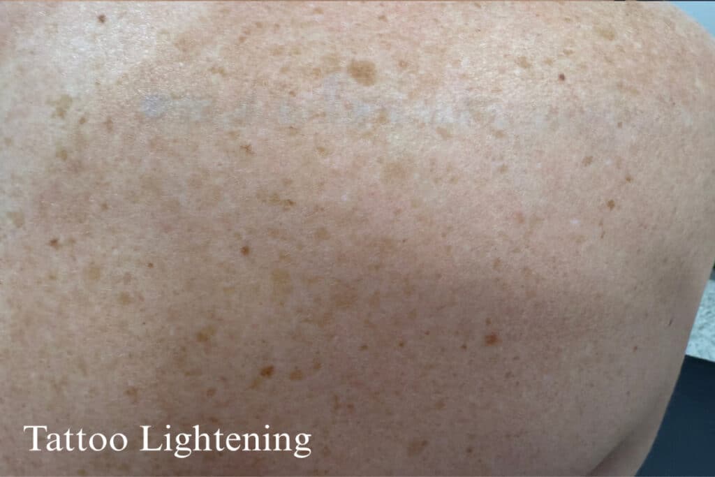 After Image: Tattoo Lightening - back