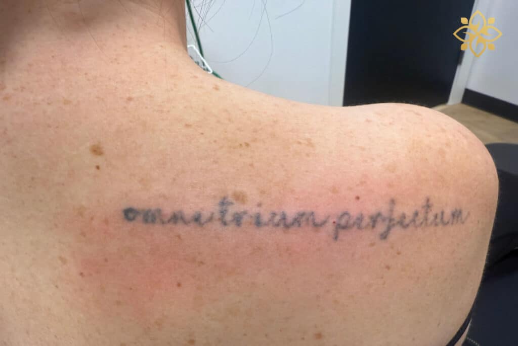 Before Image: Tattoo Lightening - back