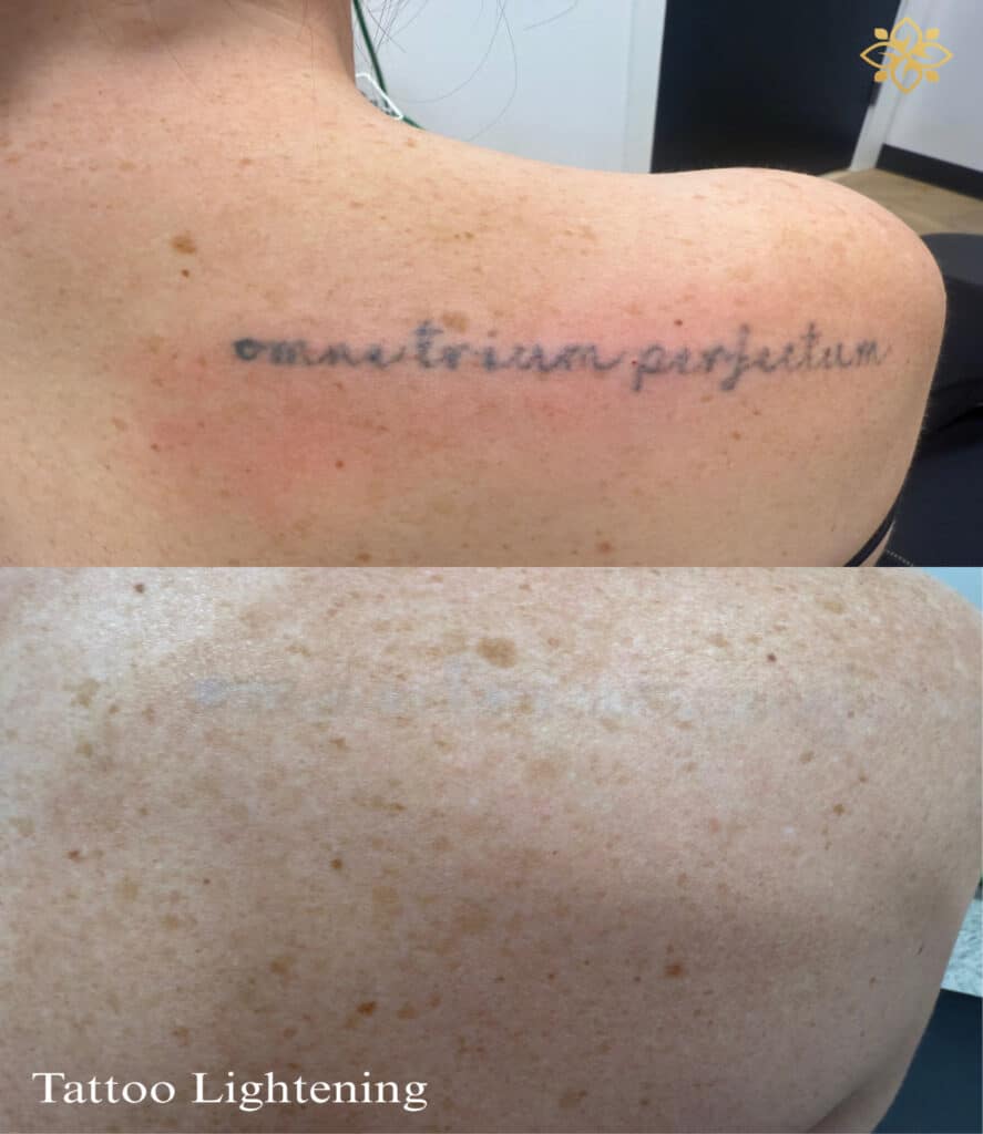 Before & After