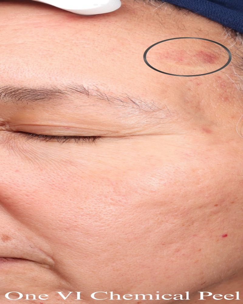 Before Image: Before & After - left-front-oblique