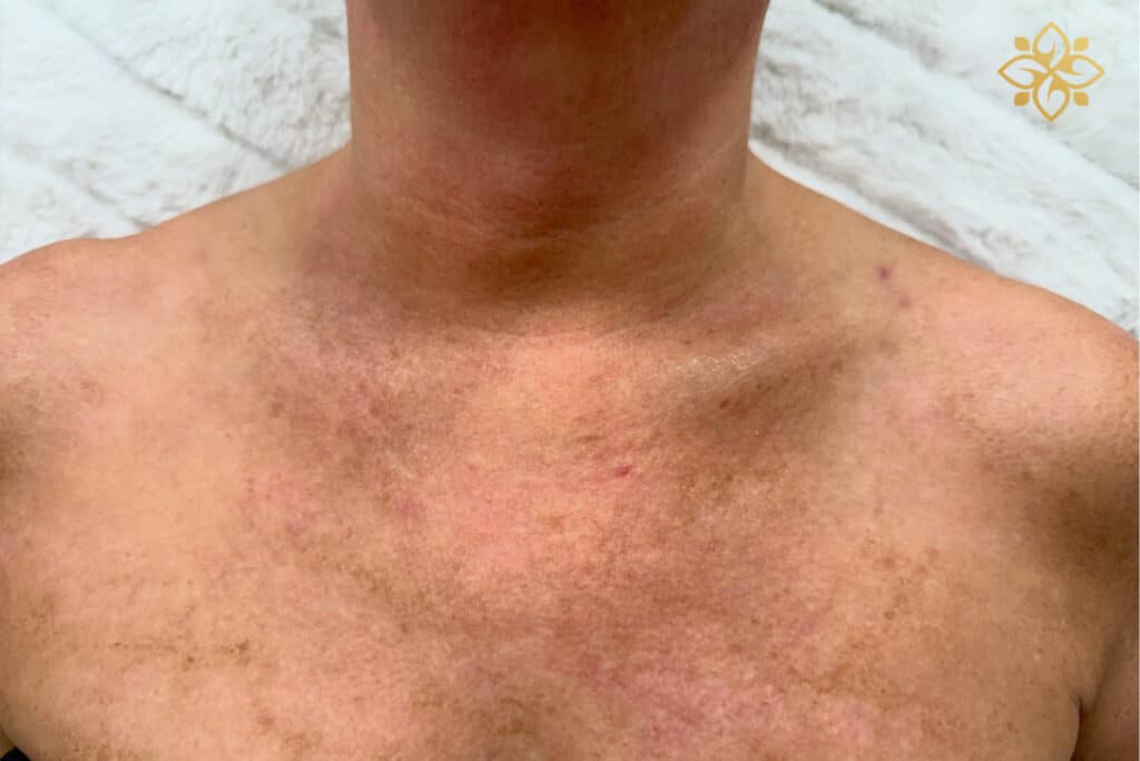 Before Image: IPL - front
