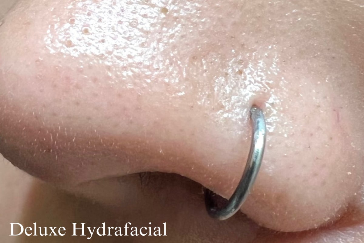 After Image: Before & After - left-front-oblique