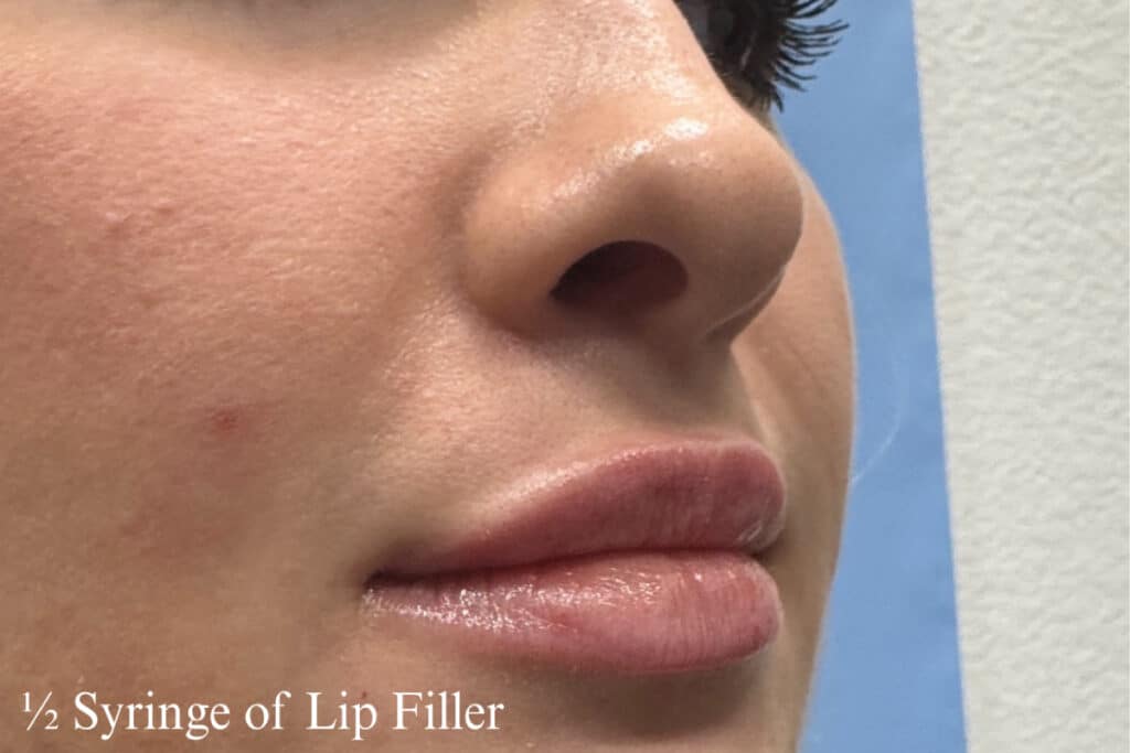 After Image: Lip Filler - right-front-oblique