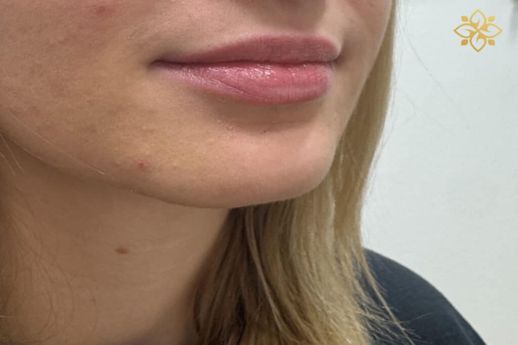 Before Image: Lip Filler - right-front-oblique
