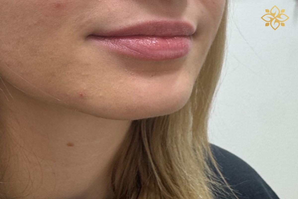 Before Image: Before & After - right-front-oblique