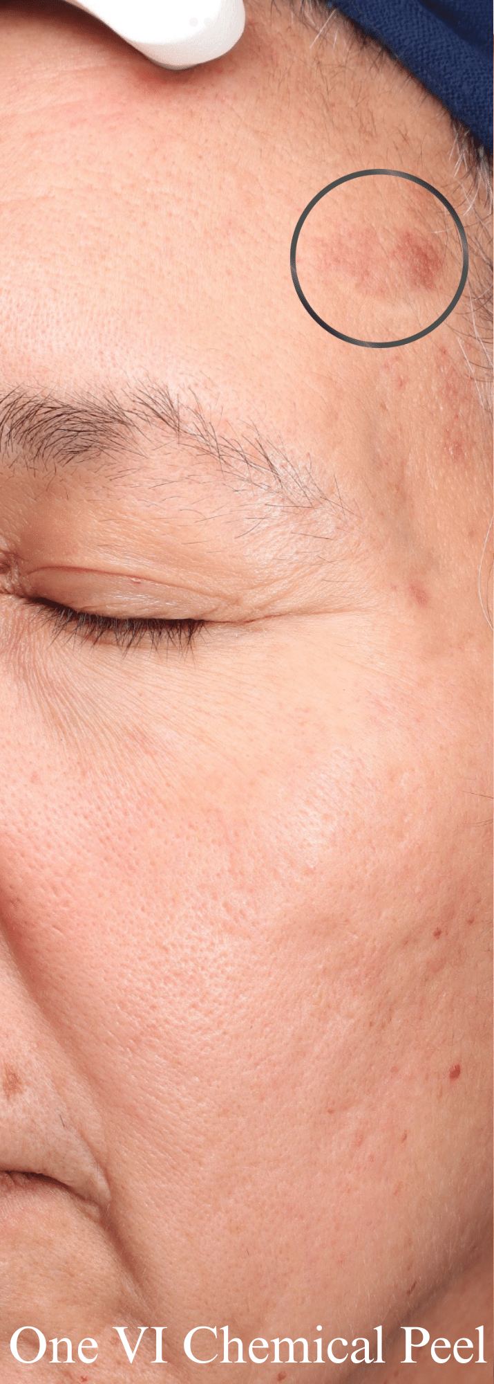 Before Image: One VI Chemical Peel - left-front-oblique