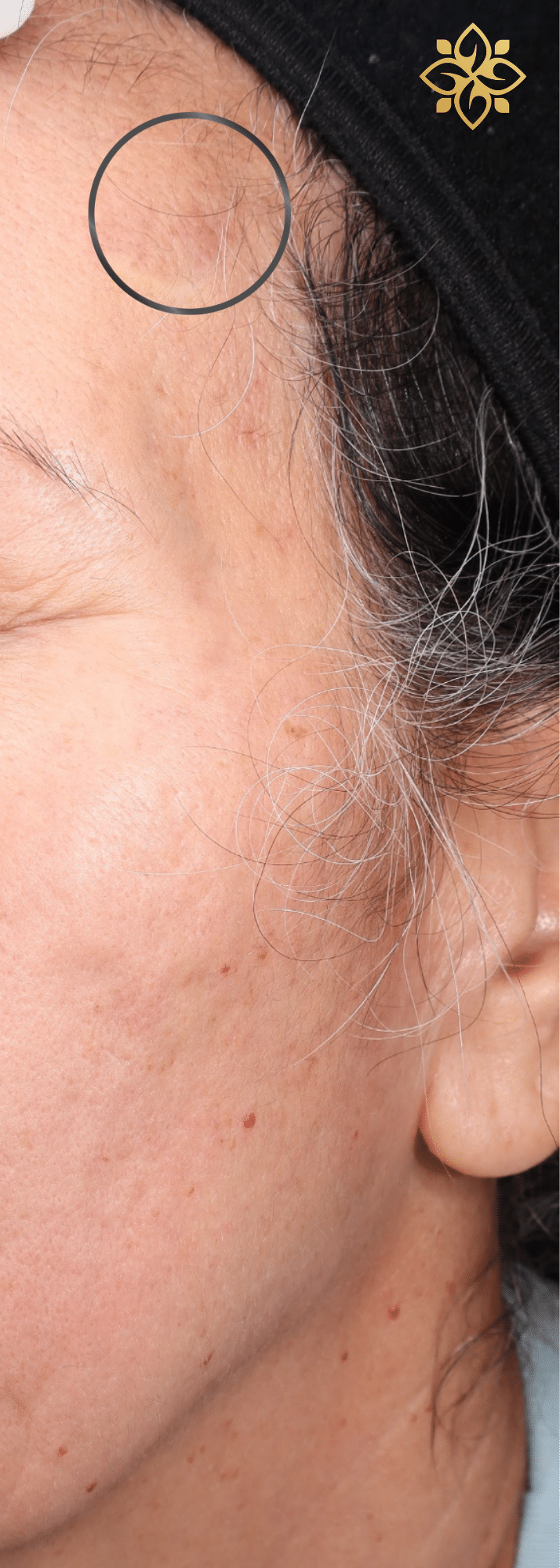 After Image: One VI Chemical Peel - left-front-oblique