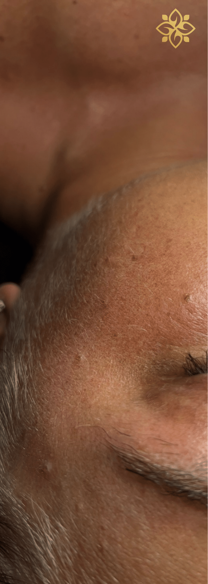 After Image: Dermaplaning - front