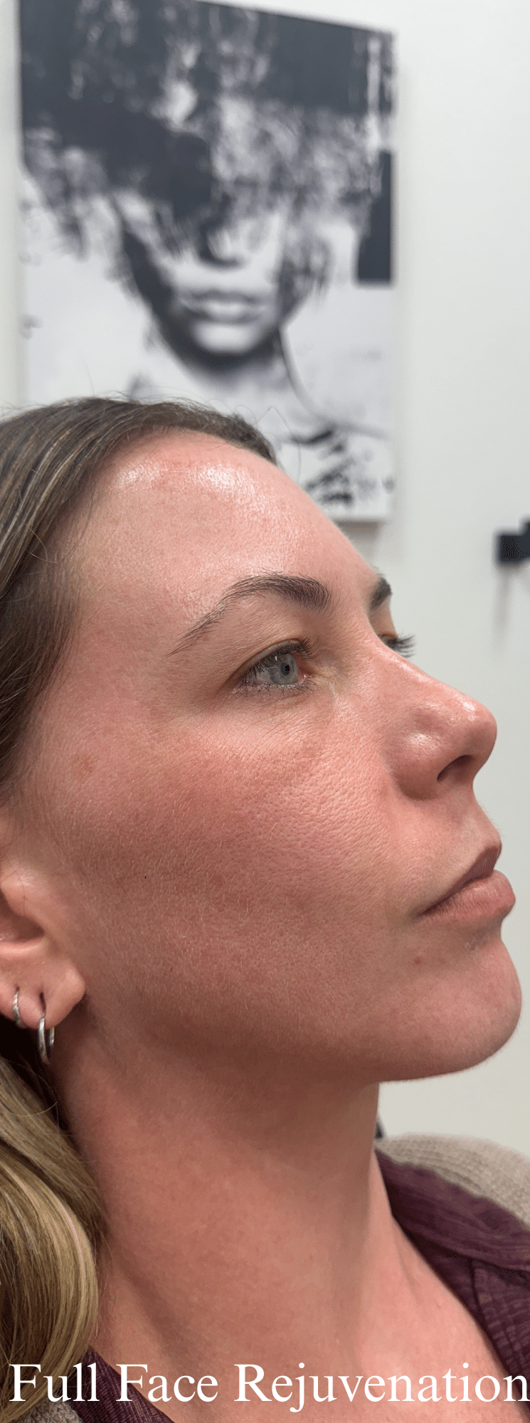 Before Image: Full Face Rejuvenation - right-front-oblique