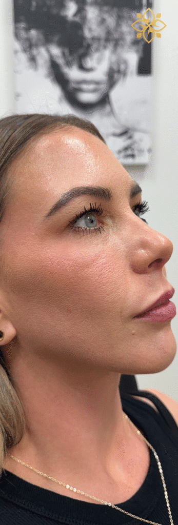 After Image: Full Face Rejuvenation - right-front-oblique