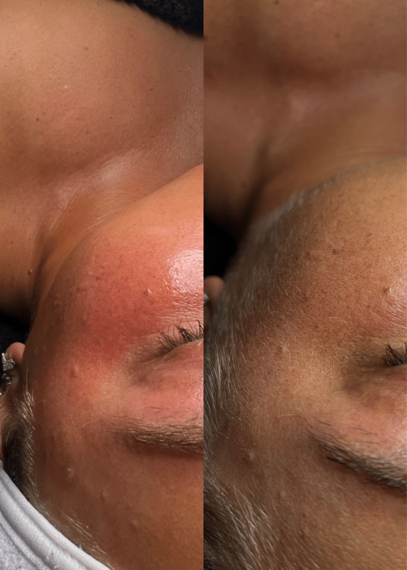 Reveal Smoother, Brighter Skin with Dermaplaning