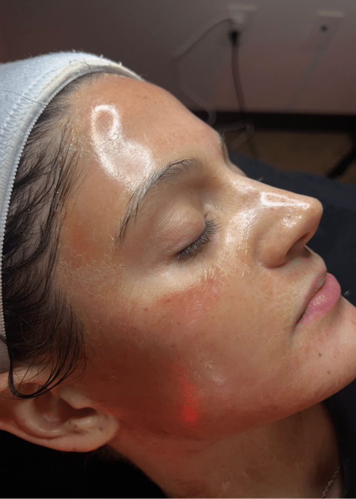 IMG_3943 Micro-needling Skin Pen