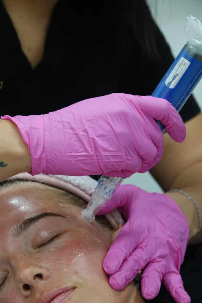 DSC02415 Micro-needling Skin Pen