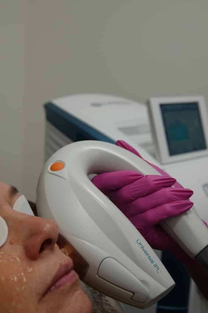 Laser Resurfacing + IPL